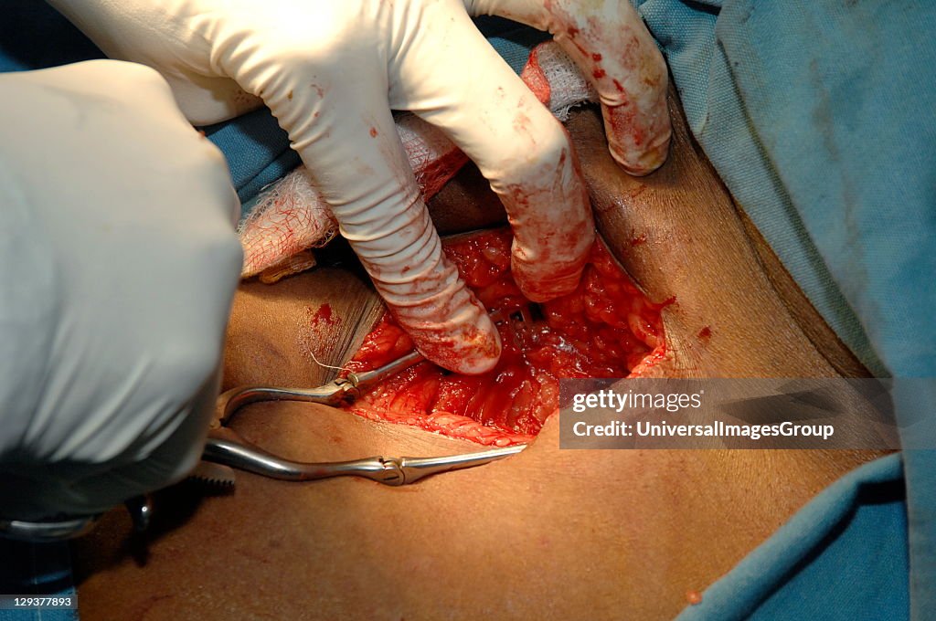 Embolectomy. Sudan, Africa.