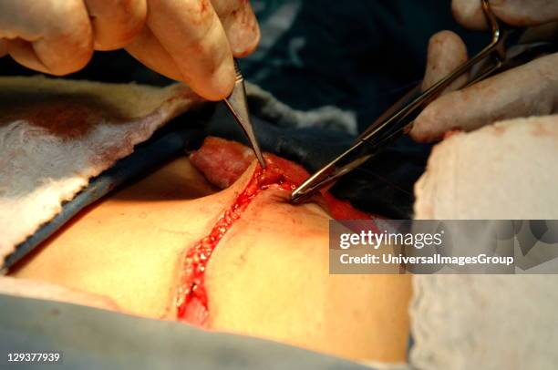 Closing the tissue. The subcutaneous tissue underneath the superior and inferior skin flaps are approximated and closed using an interrupted suture....