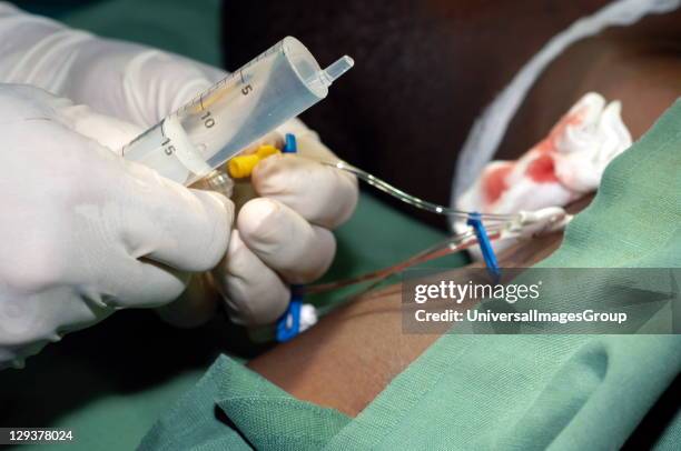 Central Venous Catheter Insertion, The surgeon prepares to flush the third port with another syringe of saline solution. Here he removes the...