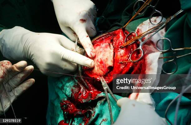 Neurosurgeon operating on a patient's brain. Here the surgeon is beginning to close the surgical wound.