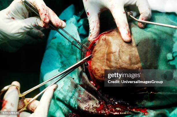 Neurosurgeon operating on a patient's brain starts to close the skin.