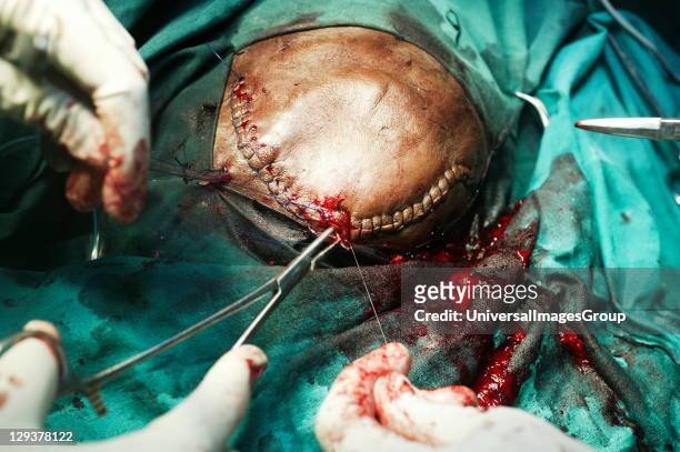 Neurosurgeon operating on a patient's brain closing the skin that covers the wound.