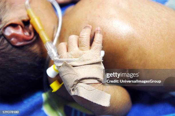 Premature baby with intravenous drip sleeping in incubator. Sudan, Africa., The drip will allow doctors and nurses to feed the baby various drugs...