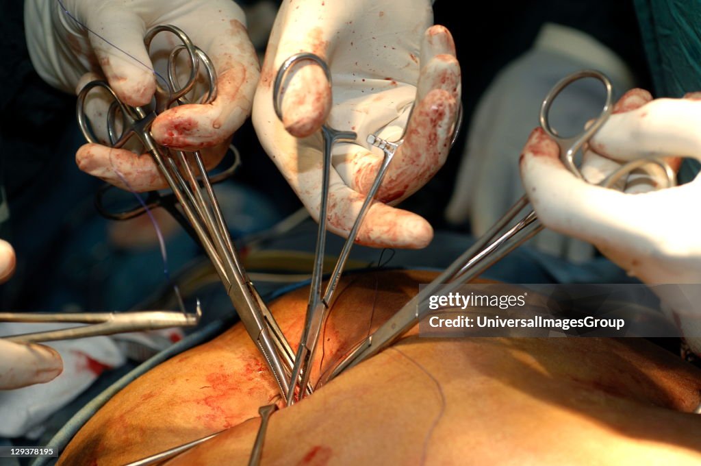 Patient during Cholecystectomy procedure. Sudan, Africa.