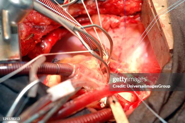 Mitral Valve Replacement. Sudan, Africa.