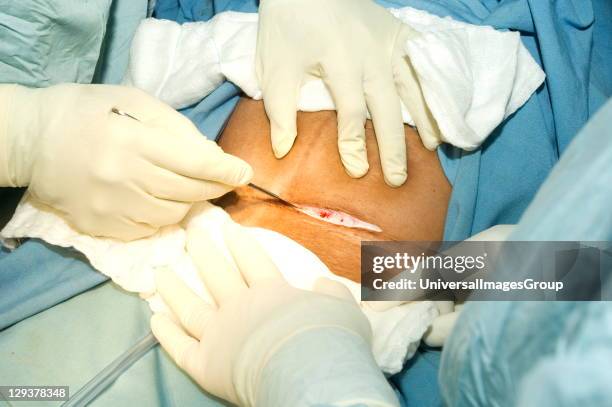 Surgeon using scalpel to make initial incision during Caesarean delivery, Transverse incision is used at level of pubic hairline to incise skin and...