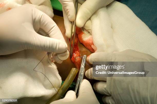 Thyroidectomy. Suture is placed in wound so that subcutaneous tissue can be secured to edges on either side. , This maximises area surrounding...