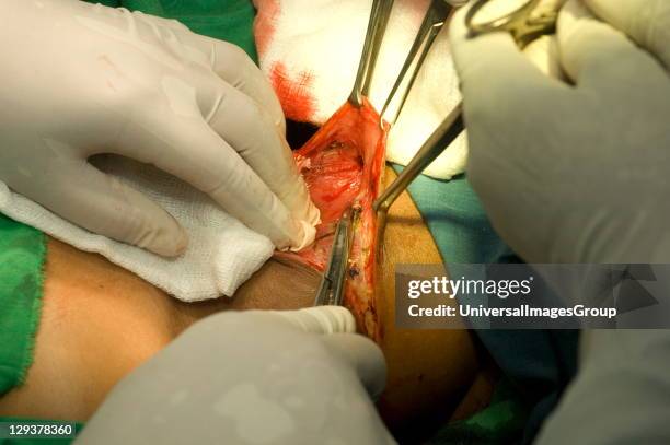 Thyroidectomy. Assistant holds Allis clamps to retract skin whilst surgeon prepares to anchor loose subcutaenous tissue to edges of wound.