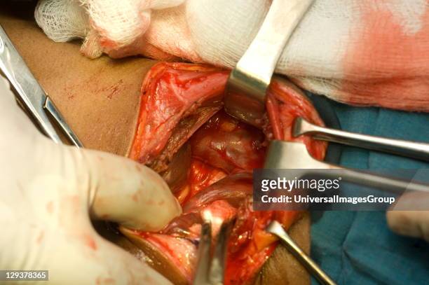 Thyroidectomy. Surgeon delves into wound to examine gland. This lobe will be spared, but he must ensure it appears normal before he proceeds. , To...