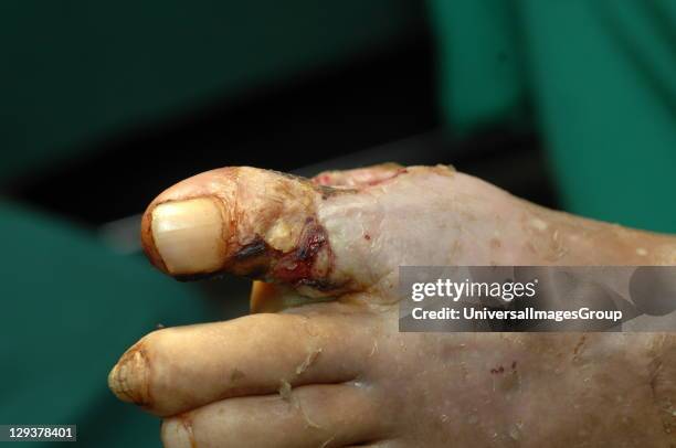 Foot with widespread destruction of human tissues due to bacterial infection, Diabetics are more susceptible to bacterial infections as high blood...