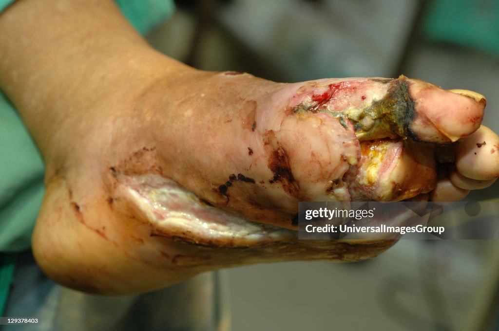 Foot with widespread destruction of human tissues due to bacterial infection