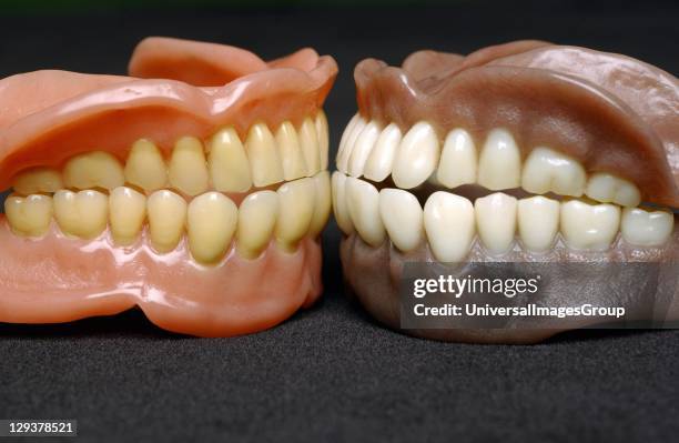 Two sets of full dentures, Dentures or false teeth are made from an acrylic base on which acrylic or ceramic teeth are mounted. Dentures are custom...