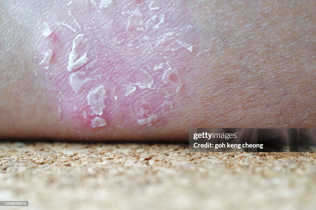 Psoriasis plaque on Asian skin