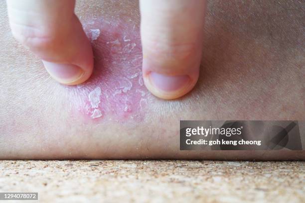 scratching psoriasis plaque close up - psoriasis skin stock pictures, royalty-free photos & images