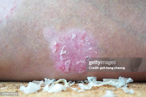 psoriasis plaques with dead skin - chronic wound stock pictures, royalty-free photos & images