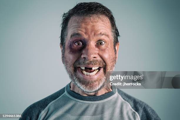 hombre feliz con ojo negro y dientes perdidos - cardenal lesión física fotografías e imágenes de stock