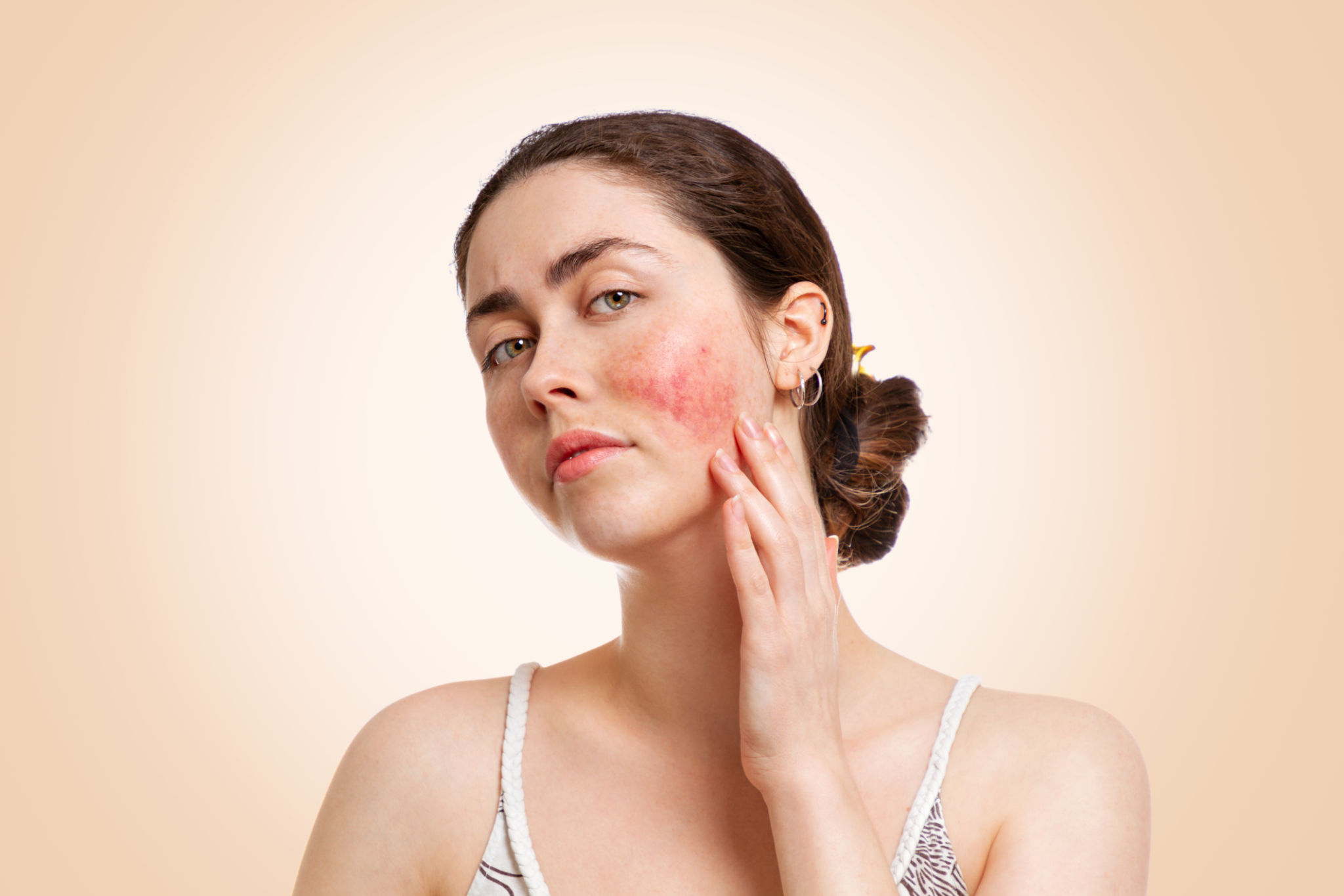 inflamed skin