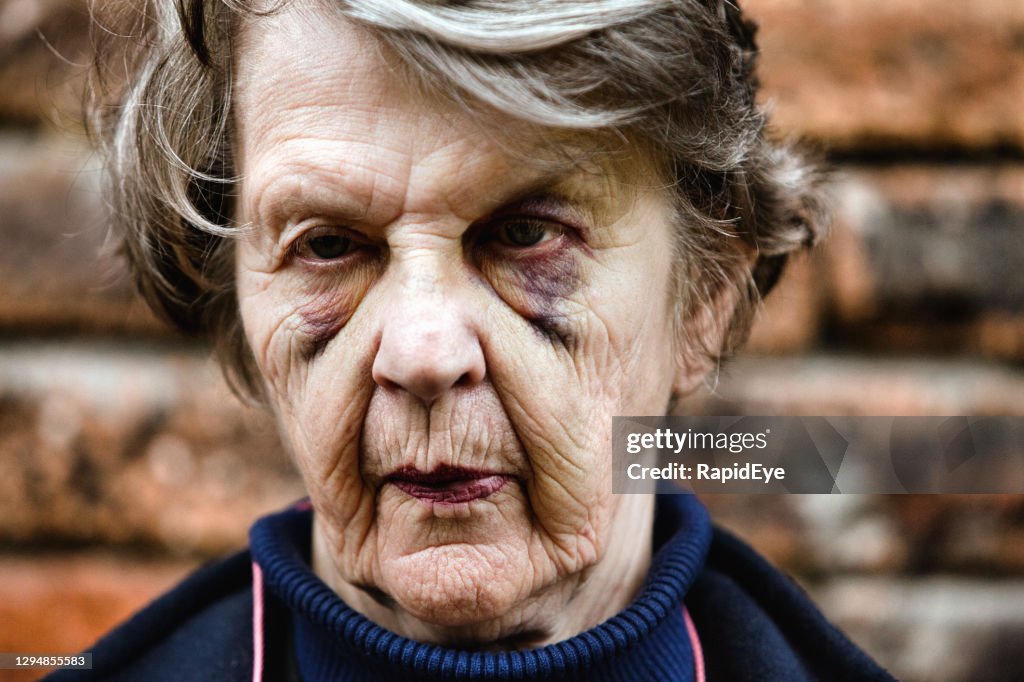 Anciana amamantando dos ojos negros después de una lesión