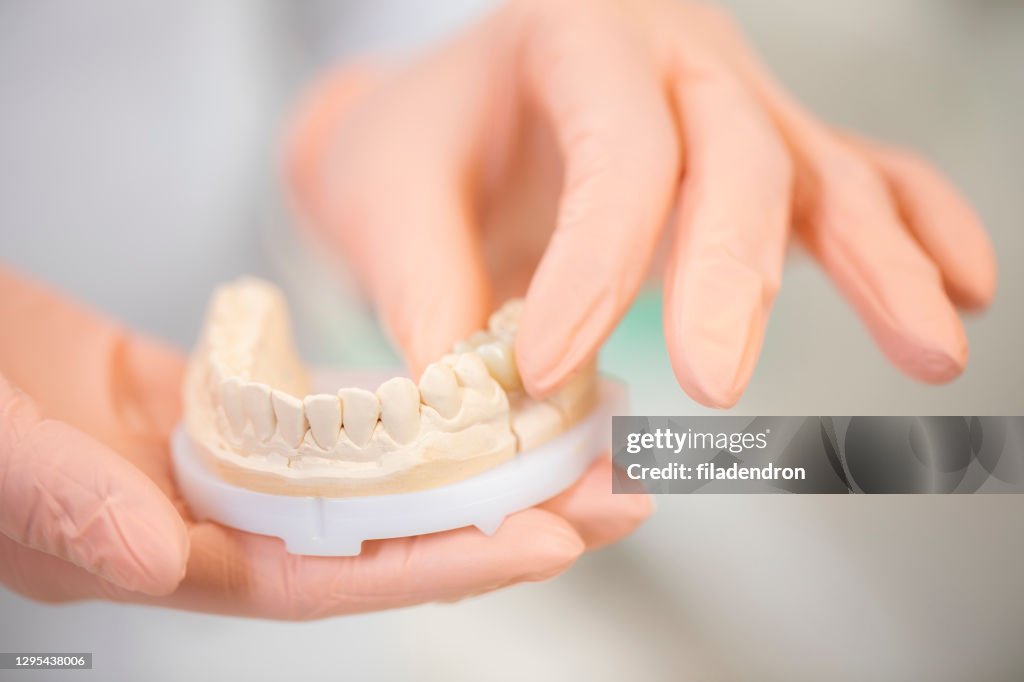 Dental plaster mould in the hands of the dentist