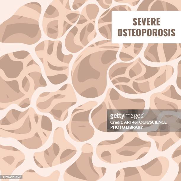 ilustrações, clipart, desenhos animados e ícones de osteoporosis, conceptual illustration - osteoporose