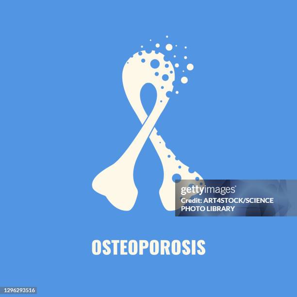 osteoporosis, conceptual illustration - osteoporose stock-grafiken, -clipart, -cartoons und -symbole