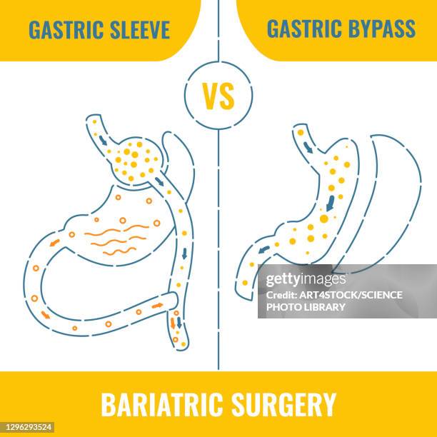 bariatric surgery, conceptual illustration - ärmel stock-grafiken, -clipart, -cartoons und -symbole