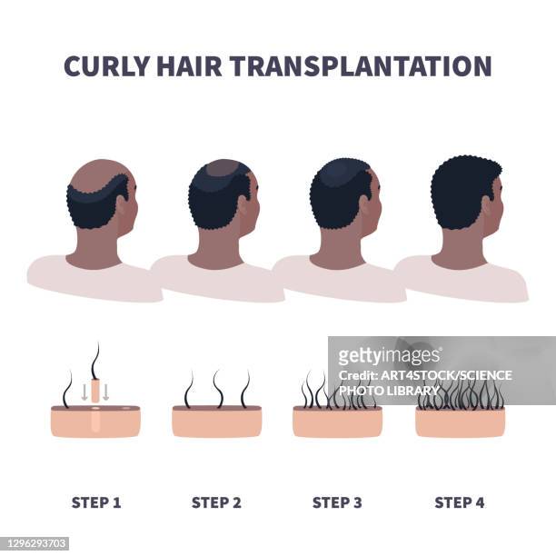 hair transplantation, illustration - haartransplantation stock-grafiken, -clipart, -cartoons und -symbole