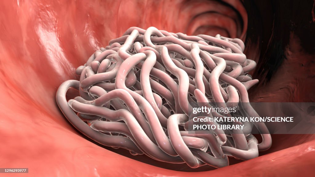 Round Worms In Human Intestine Illustration High-Res Vector Graphic ...