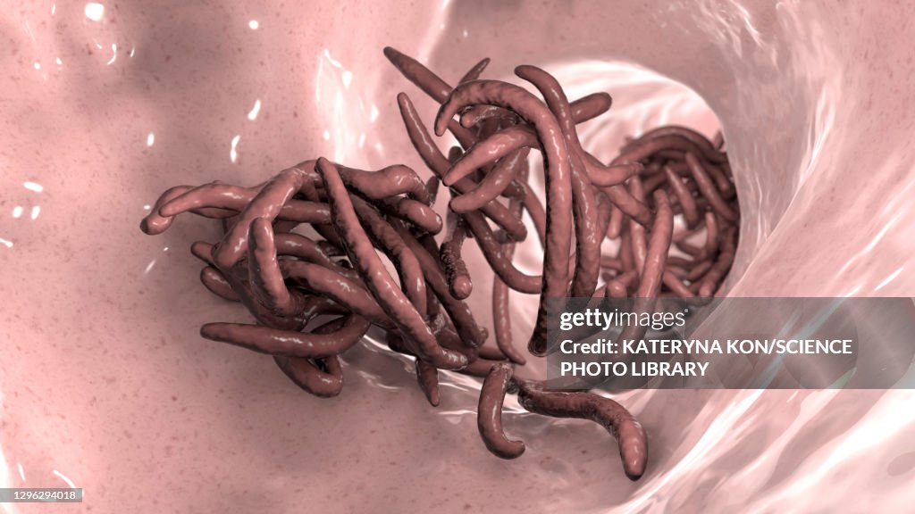 Roundworms In Humans Round Worms In Human Intestine Illustration High-Res Vector Graphic ...