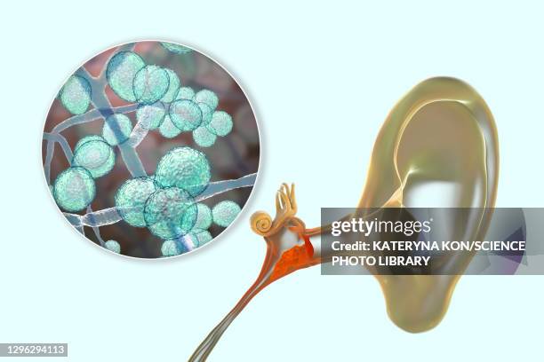 chronic fungal otitis media ear infection, illustration - infectious disease stock illustrations
