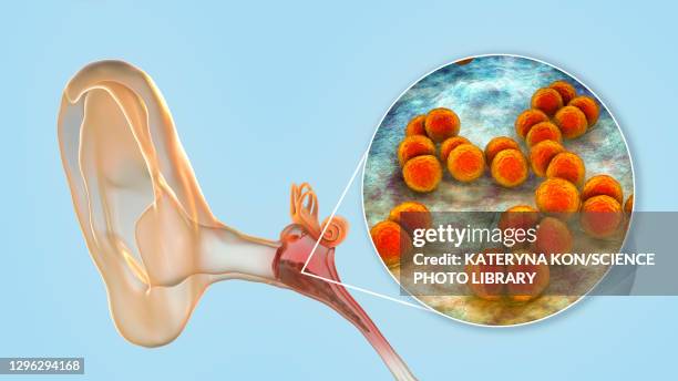 otitis media ear infection, illustration - streptococcus pneumoniae stock illustrations