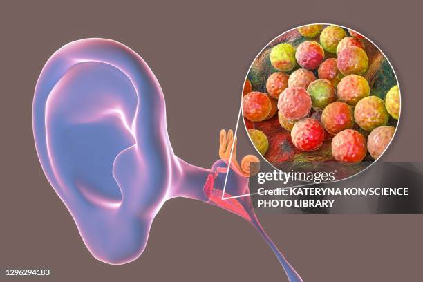 otitis media ear infection, illustration - staphylococcus aureus stock illustrations