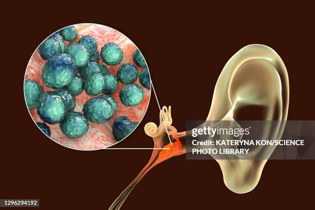 Spores In Ear Otitis Media Ear Infection Illustration High-Res Vector Graphic - Getty ...