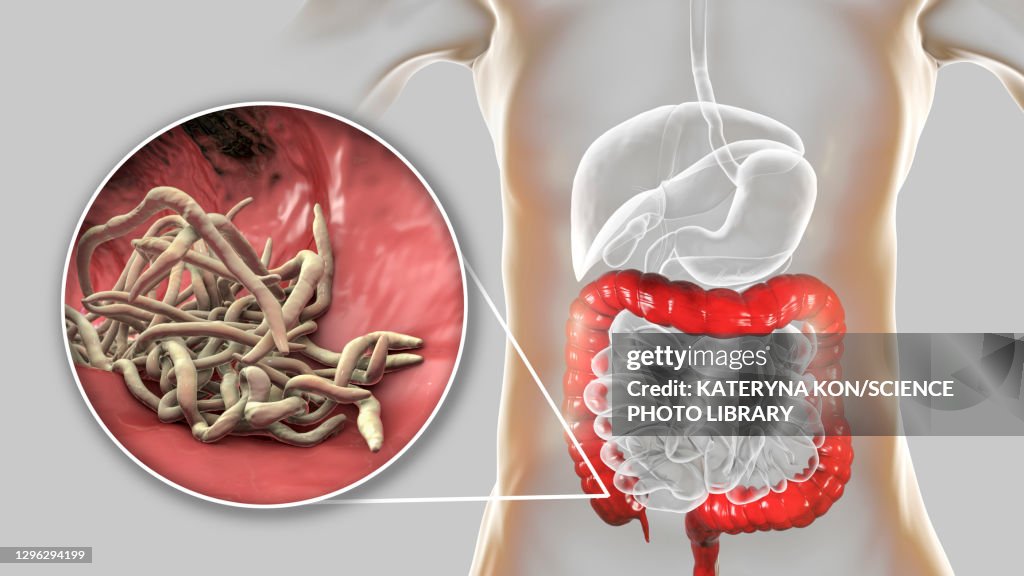 Intestine Rope Round Worms In Human Large Intestine Illustration High-Res Vector ...