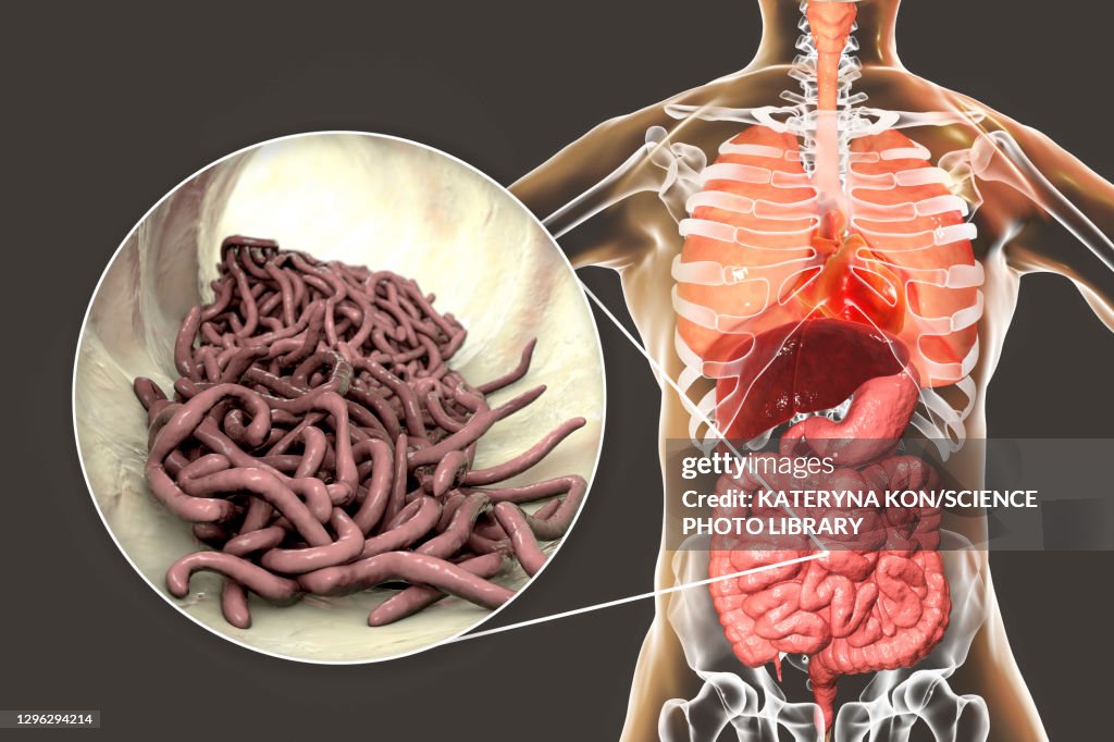 Round worms in human intestine, illustration