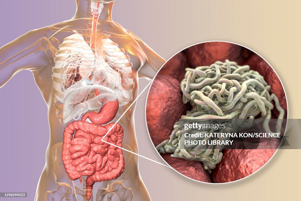 Round worms in human intestine, illustration
