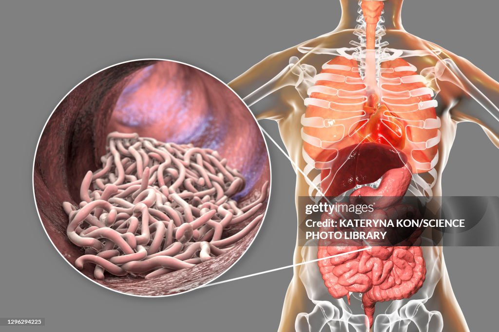 Round worms in human intestine, illustration