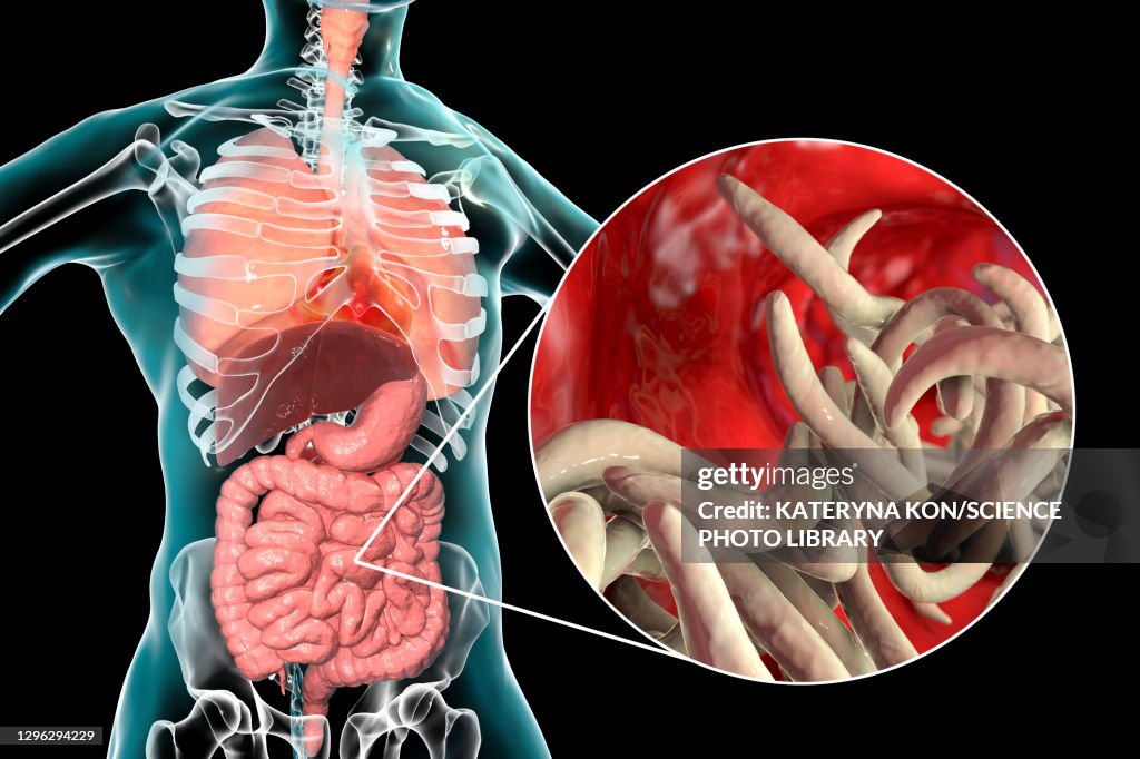 Round worms in human intestine, illustration