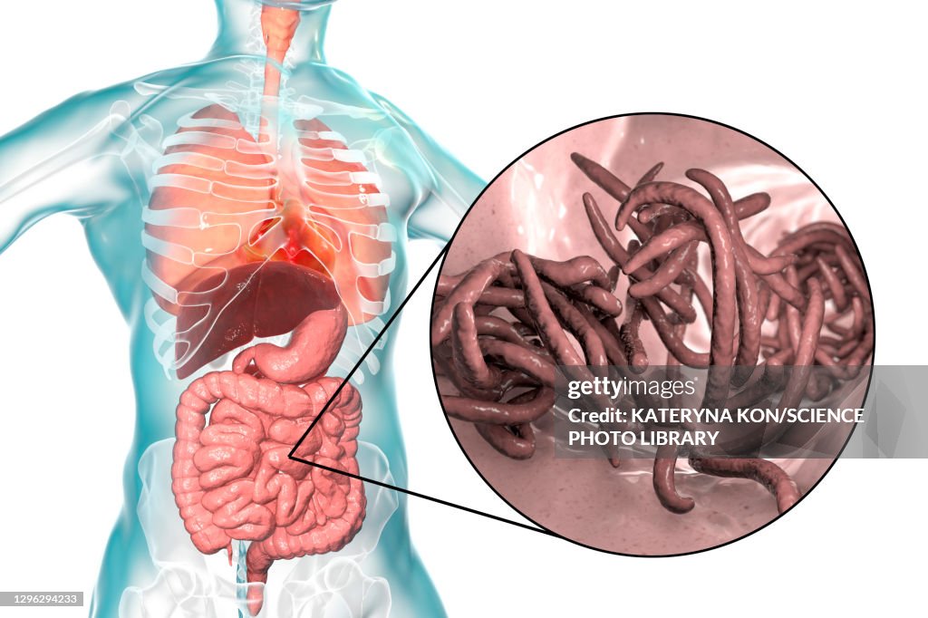 Round worms in human intestine, illustration