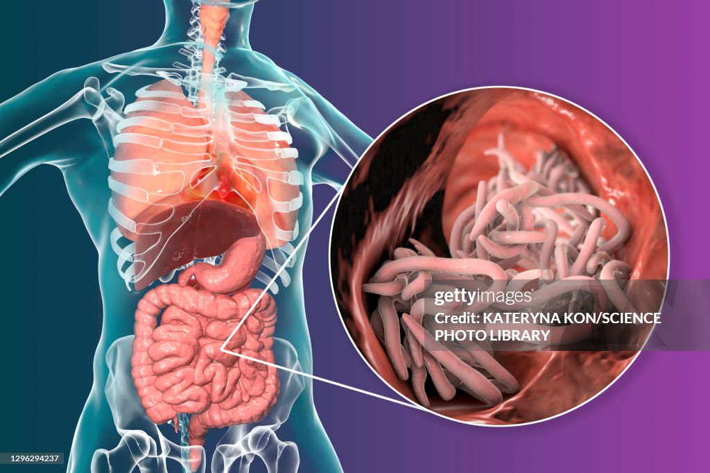Round worms in human intestine, illustration