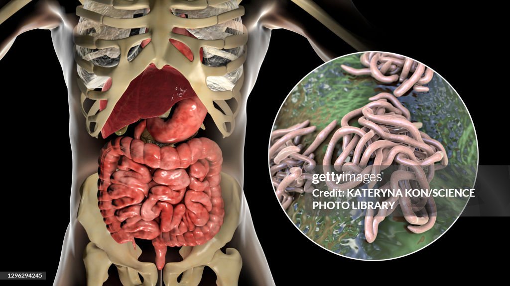 Round worms in human intestine, illustration