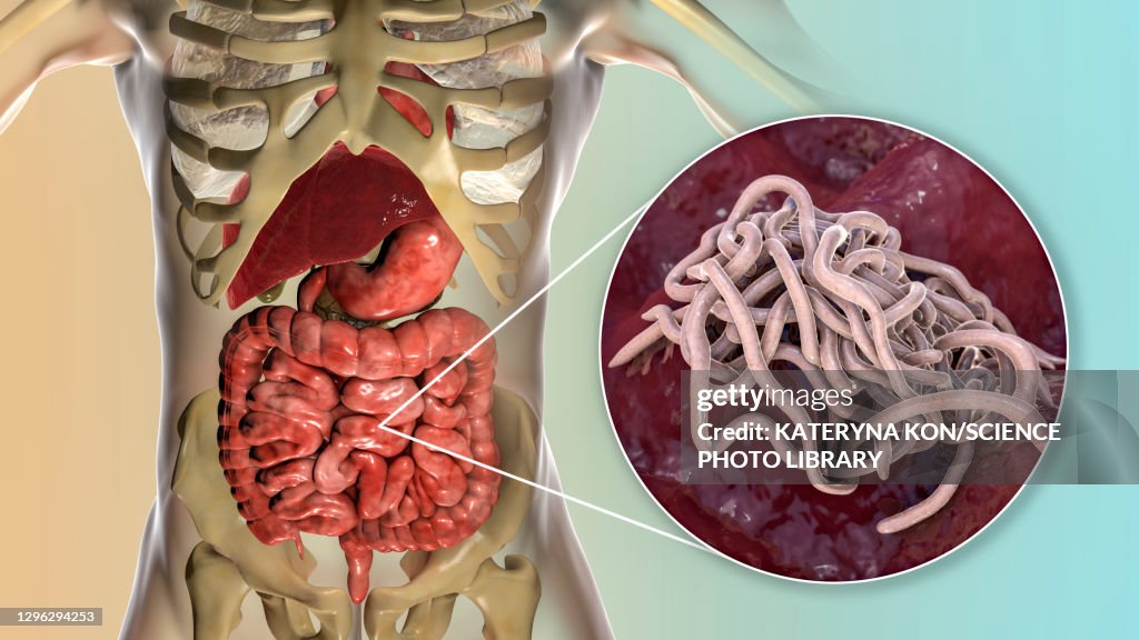 Round worms in human intestine, illustration