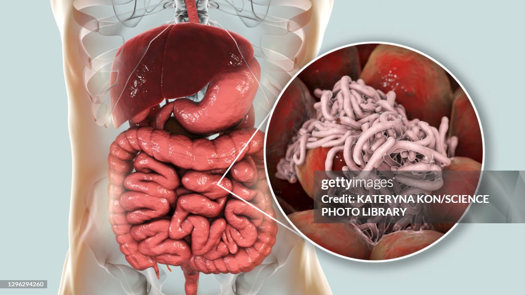 Round worms in human intestine, illustration