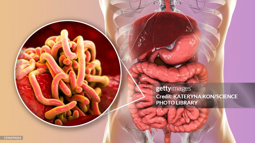 Round worms in human intestine, illustration