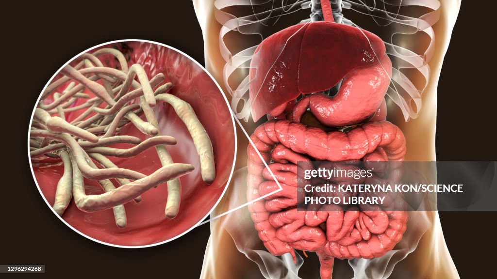 Round worms in human intestine, illustration
