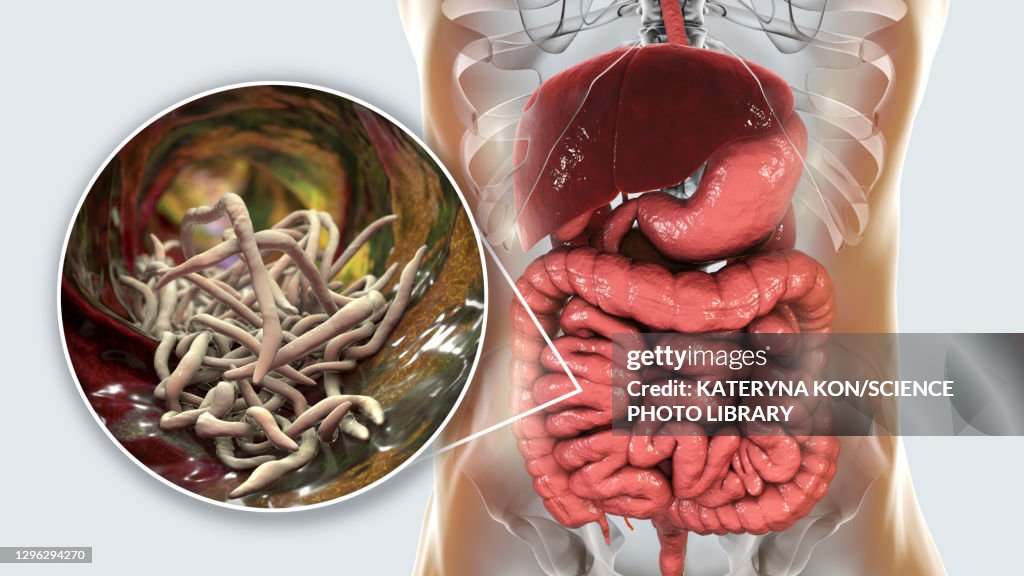 Round worms in human intestine, illustration