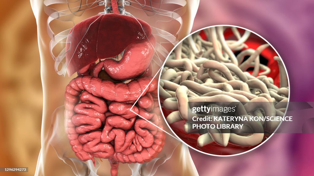 Round worms in human intestine, illustration