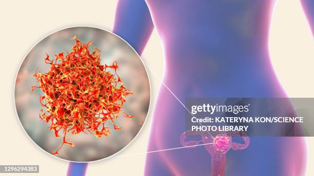 103点の卵巣癌イラスト素材 Getty Images 103点の卵巣癌イラスト素材 Getty Images