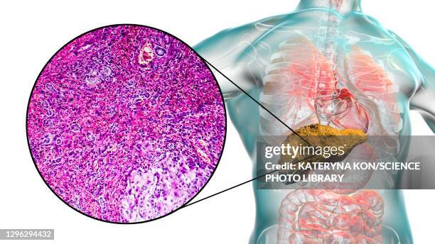 liver cirrhosis, illustration and light micrograph - light micrograph stock illustrations