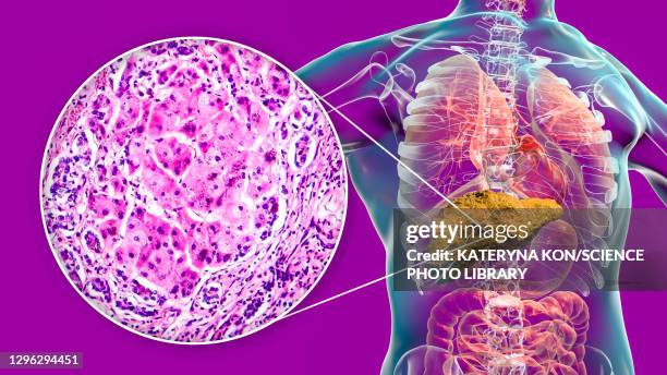 liver cirrhosis, illustration and light micrograph - light micrograph stock illustrations